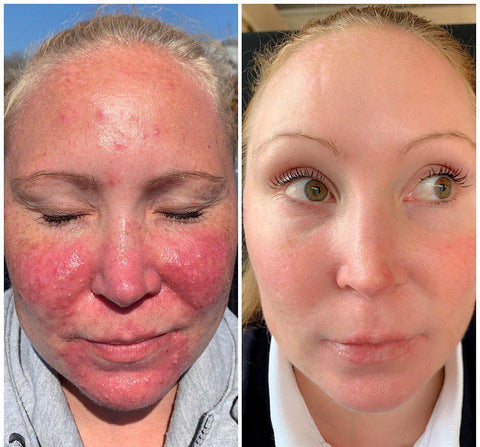 Made in the USA ✨Newly developed Bee Venom Skin Repair Cream⏰ Last day 80% off 💕（副本）