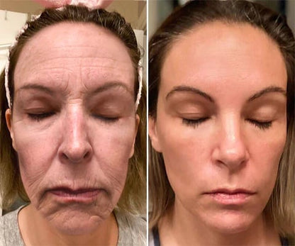 (Made and Shipped from USA) 🧑‍⚕️QCHZOC® Botox Bee Venom Wrinkle Removal Cream