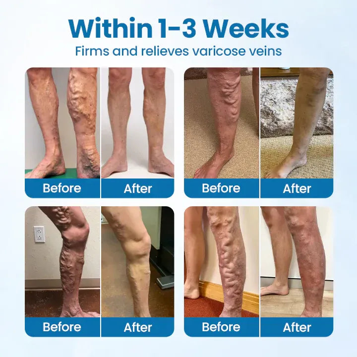 SouthMoon Herbal Spray-✅ Clinically proven to eliminate varicose veins in just 7 days!