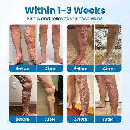 SouthMoon Herbal Spray-✅ Clinically proven to eliminate varicose veins in just 7 days!